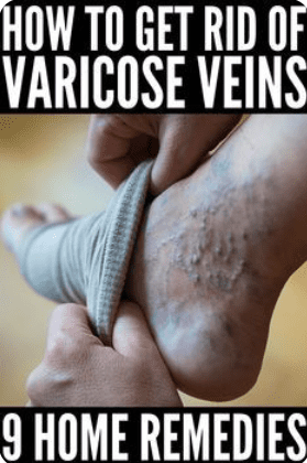 Varicose Veins