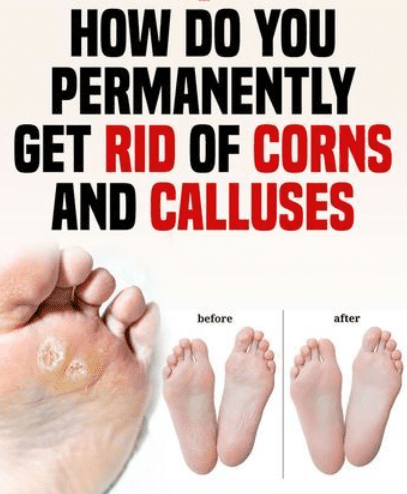 natural ways to get rid of corns and calluses at home