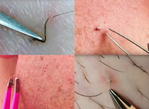 What Is An Ingrown Hair