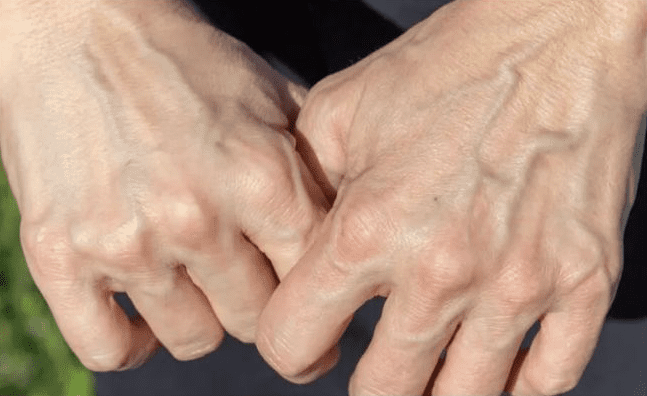 What Visible Veins Really Mean